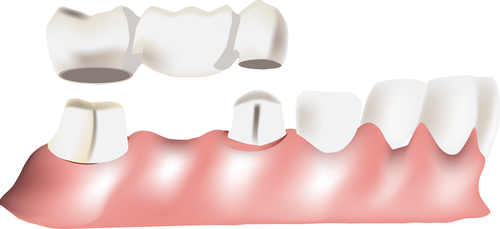 dental bridge work